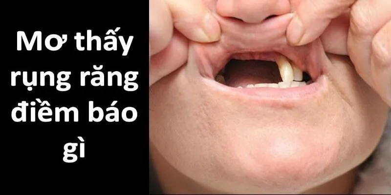 Mơ thấy rụng răng là điềm báo gì?